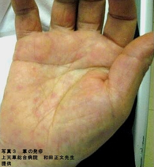 掌の発疹の画像3